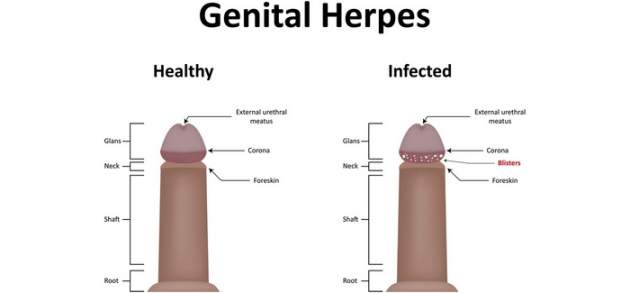 Genitálny herpes