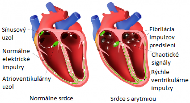 srdce a arytmia