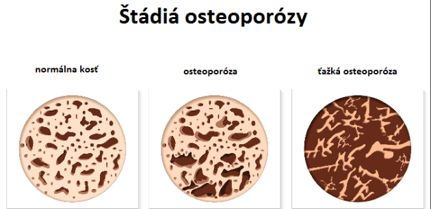 Štádiá osteoporózy Štádiá osteoporózy
