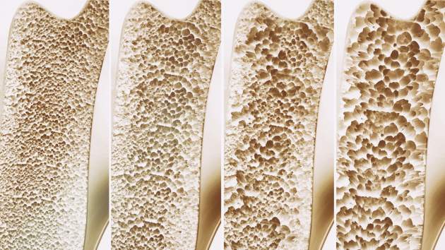 štádiá osteoporózy štádiá osteoporózy