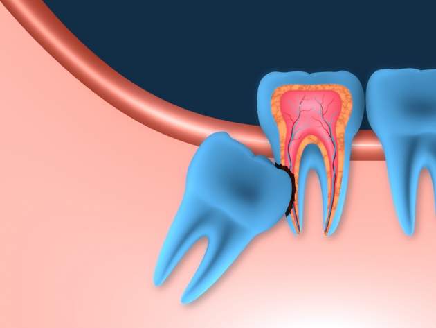 Zaklinený zub