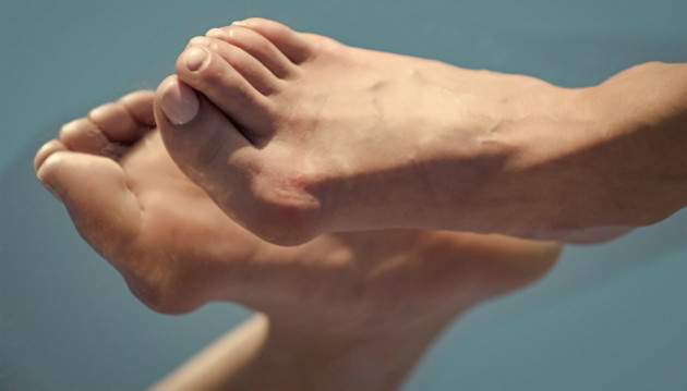 Hallux valgus Hallux valgus