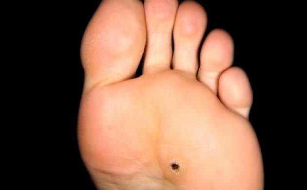 Kurie oko (clavus) Kurie oko (clavus)