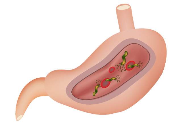 Helicobacter pylori, gastritída a vredové choroby Helicobacter pylori, gastritída a vredové choroby