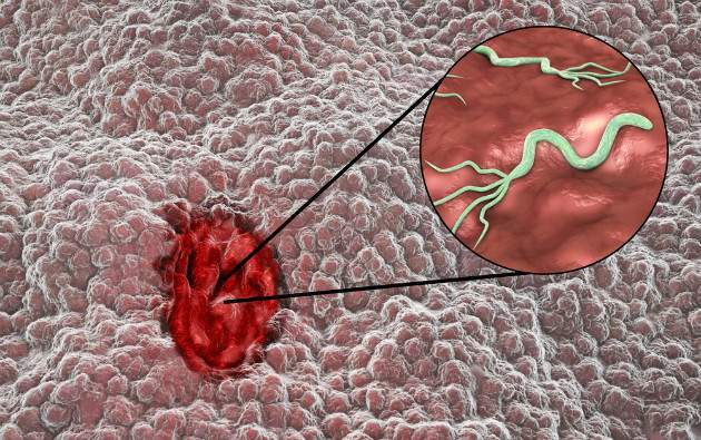 Helicobacter pylori a vredové choroby Helicobacter pylori a vredové choroby
