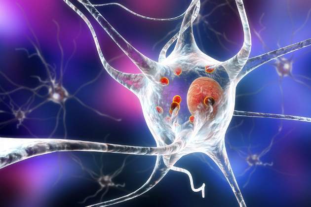 Neuróny pri Parkinsonovej chorobe Neuróny pri Parkinsonovej chorobe