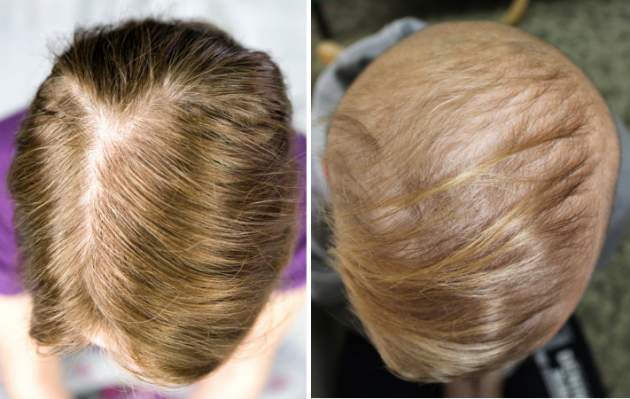 alopecia - vypadávanie vlasov alopecia - vypadávanie vlasov