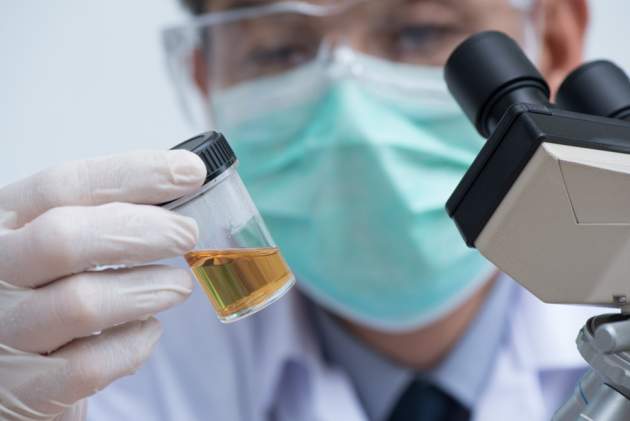 Test moču na rakovinu prostaty Test moču na rakovinu prostaty