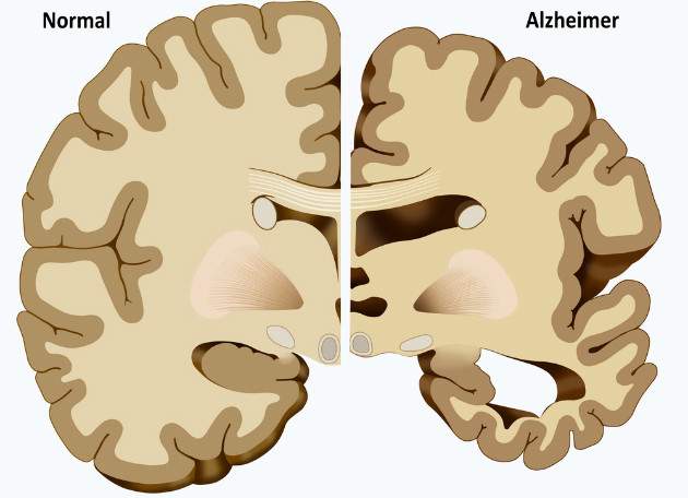 Alzheimerova choroba Alzheimerova choroba