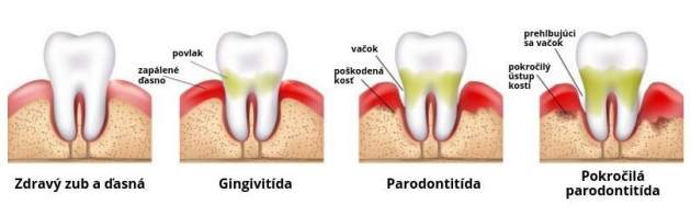 Štádiá parodontitídy , paradentozy Štádiá parodontitídy , paradentozy