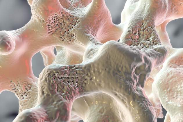 3D snímok kostného tkaniva postihnutého osteoporózou 3D snímok kostného tkaniva postihnutého osteoporózou
