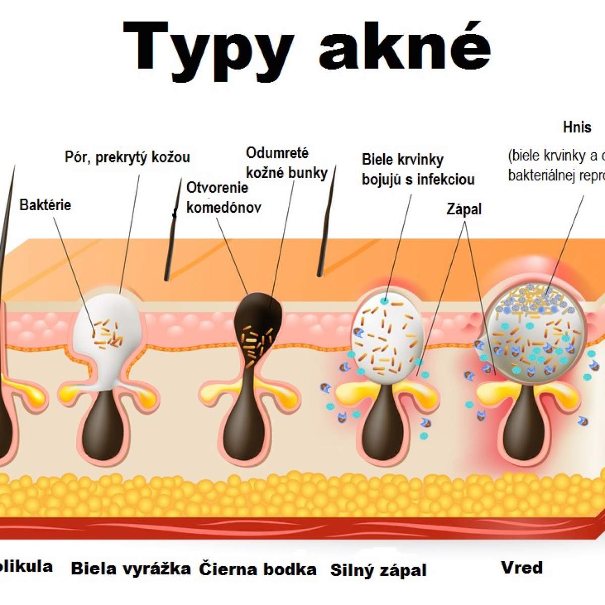 Akné - Typy akné (5 / 5) - Galéria - ZDRAVIE.sk