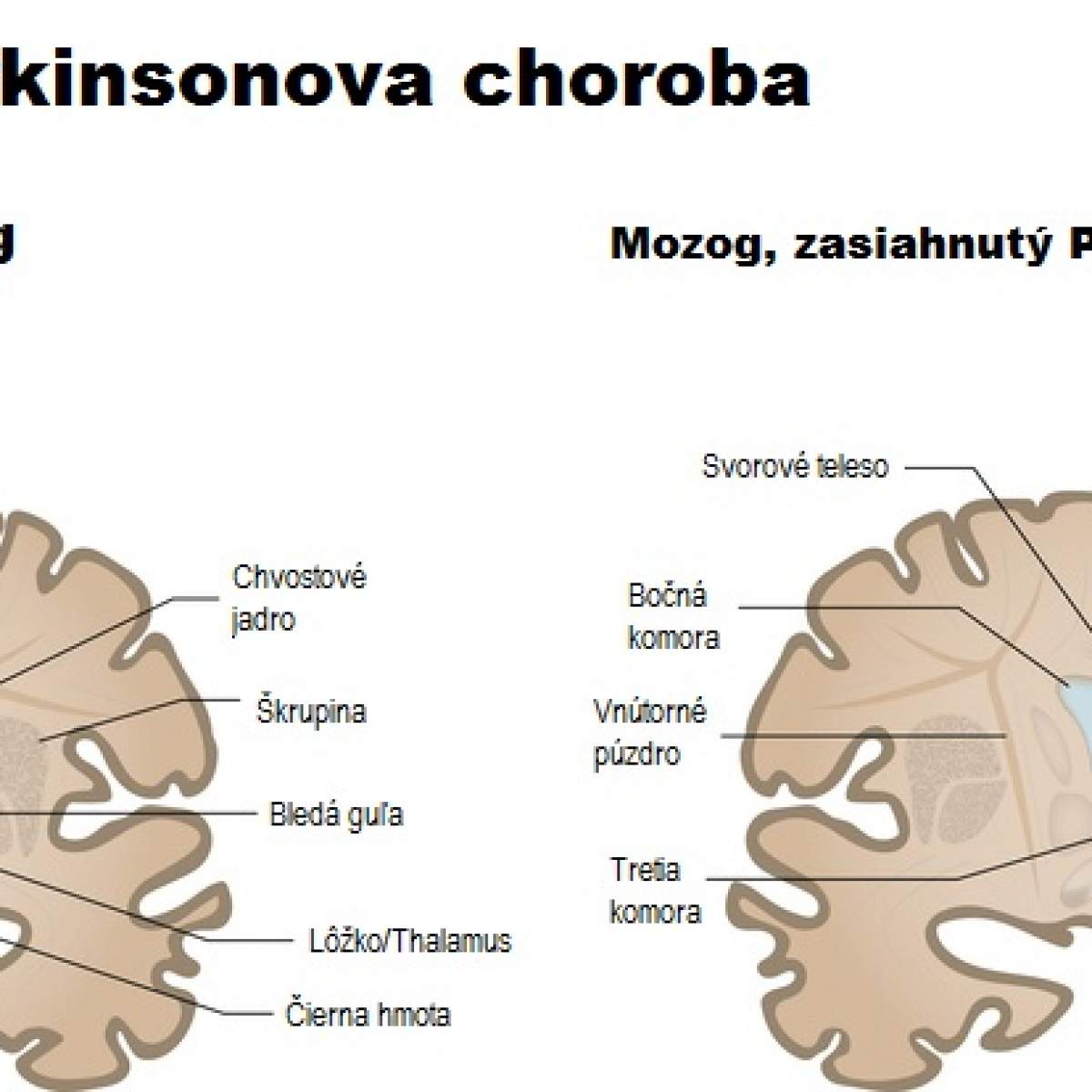 parkinsonova-choroba-parkinsovova-choroba-mozog-10-10-gal-ria