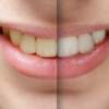 Uvažujete o bielení zubov? Toto by ste mali vedieť