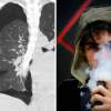 Lekárske snímky odhaľujú, aké poškodenia zrejme spôsobuje fajčenie elektronických cigariet