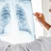 Porazíme rakovinu pľúc?
