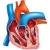 Rakovina srdcovej predsiene (atriálny myxóm)