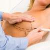 Zmenšenie prsníkov - modelácia prsníkov - mammoplastika