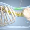 Proti bolesti chrbta intervenčnou liečbou
