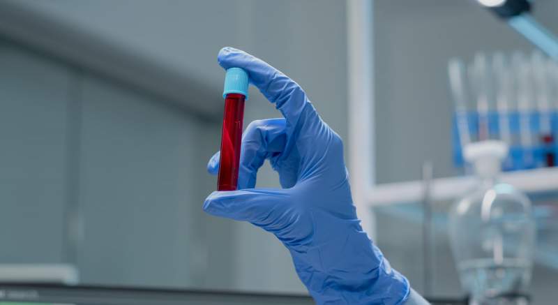 Unikátny krvný test od slovenských vedcov dokáže odhaliť už skoré štádium rakoviny prostaty!