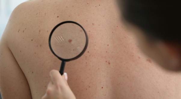 Po lete nezabudnite na znamienka: kontrola vám môže zachrániť život