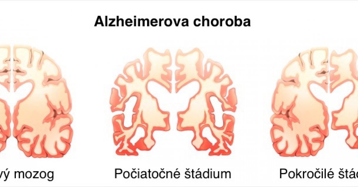 Alzheimerova choroba Alzheimerova choroba mozog (1 / 2) Galéria
