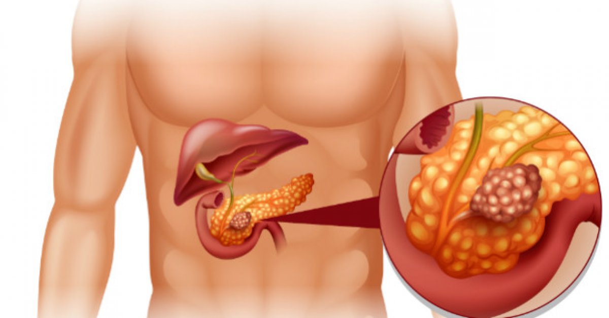 Симптомы рака поджелудочной